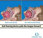 Clear Silicone Anti-Snoring Mouthpiece – Soft Reusable Sleep Aid for Comfortable Night Use
